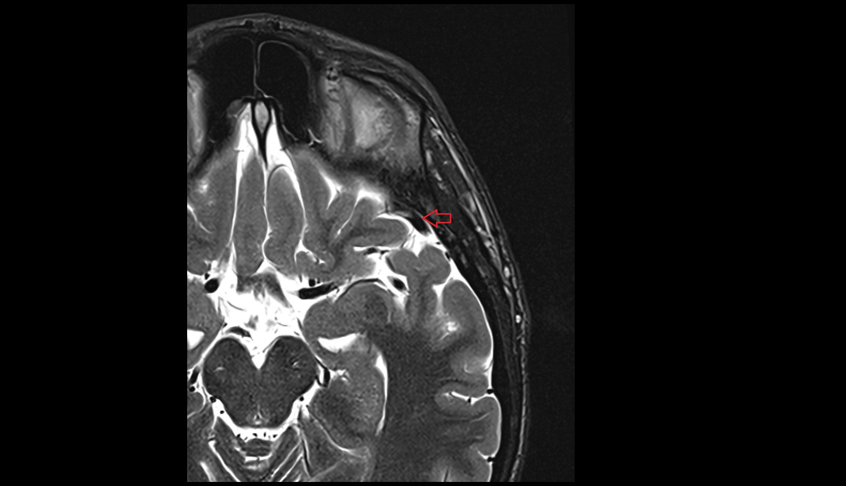 Superficial middle cerebral vein MRI 3T axial image