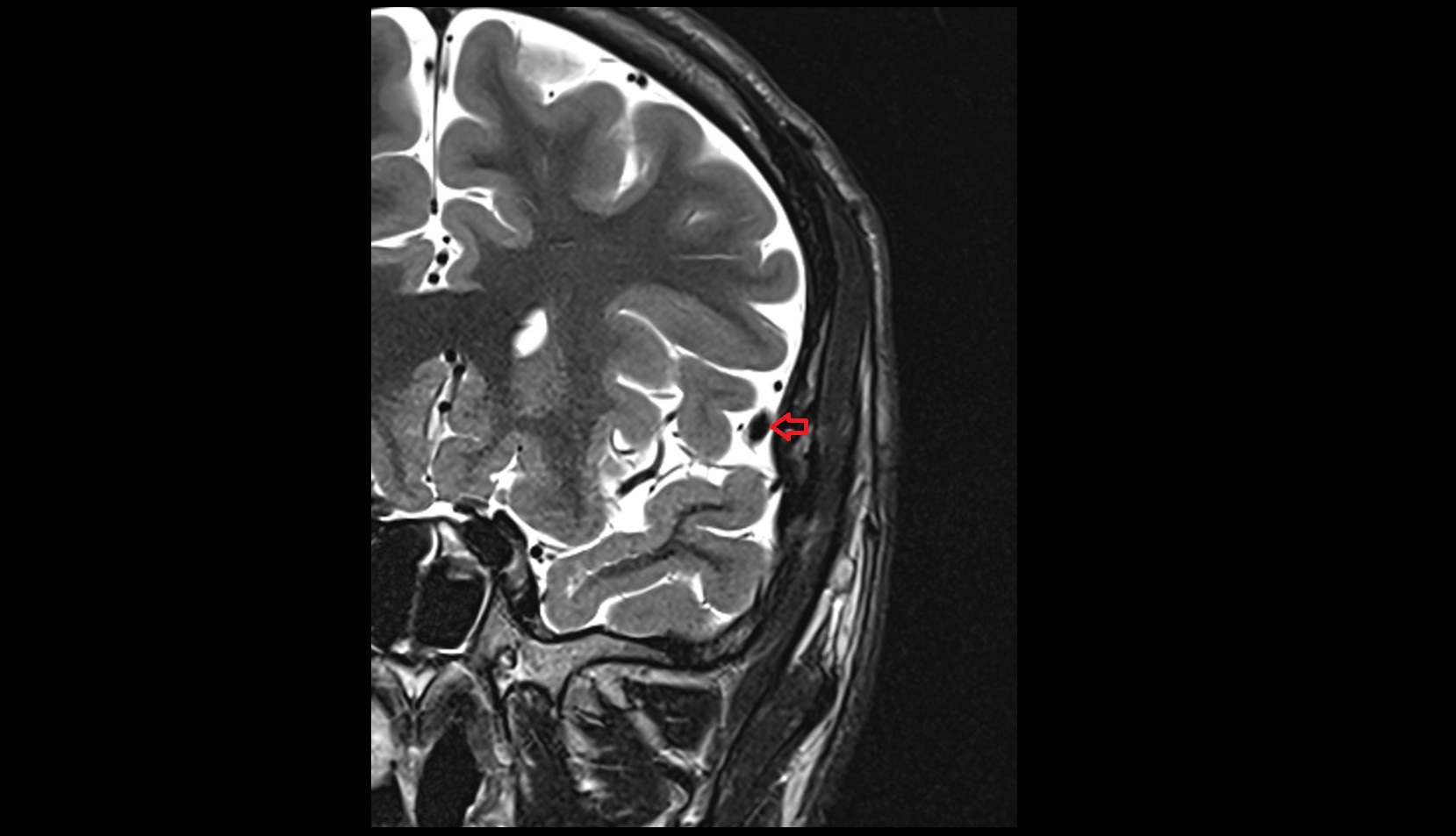 Superficial middle cerebral vein MRI 3T coronal image