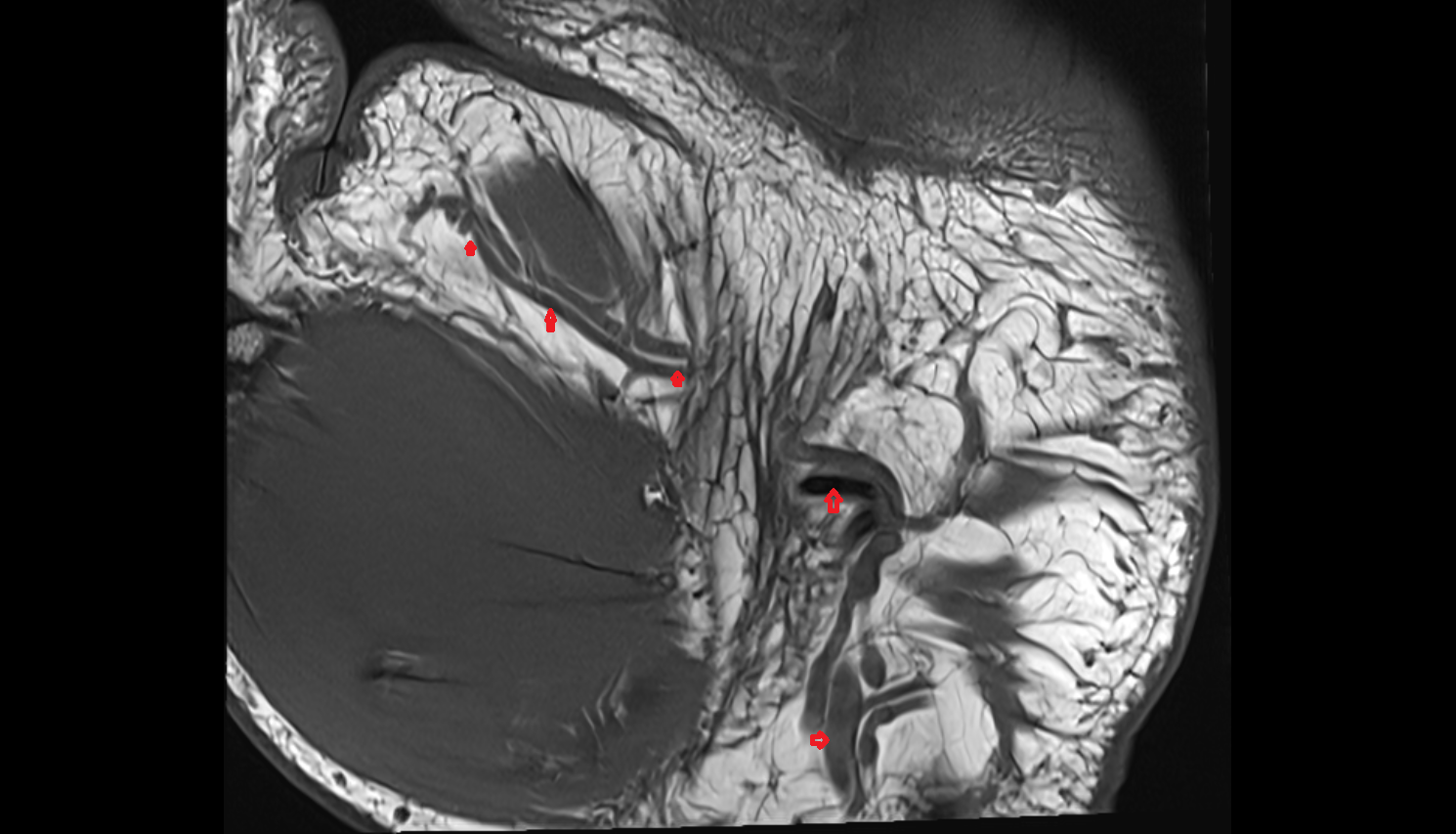 Superficial palmar arch coronal cross sectional anatomy 3T MRI AI enhanced radiology image-img-00000-00000_00002