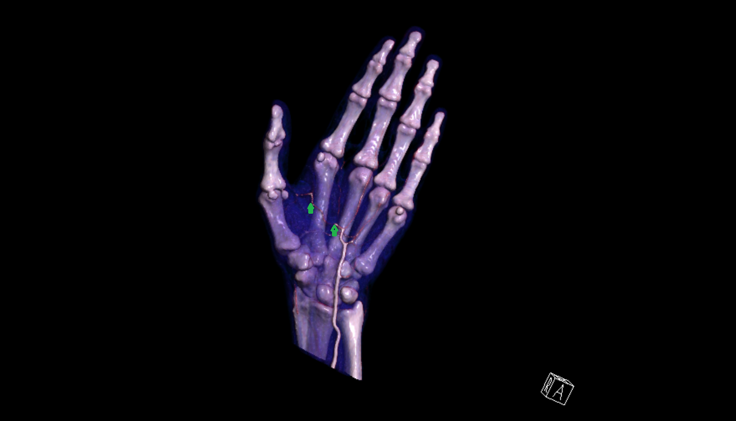 Superficial palmar arch of hand 3D VRT  CT image