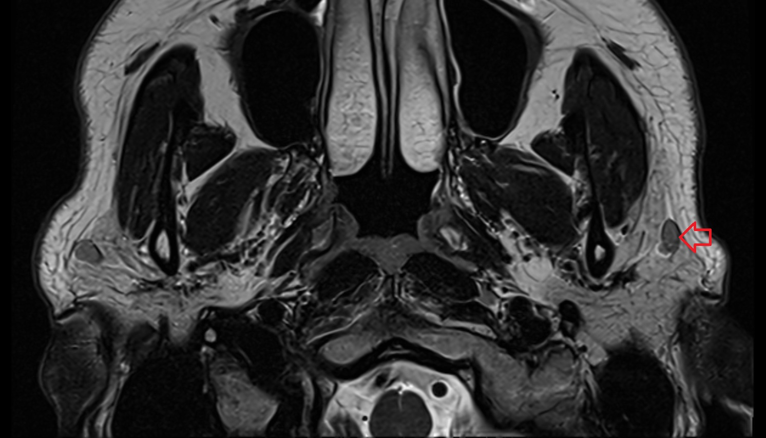 Superficial parotid lymph nodes mri axial  image -img-00000-00000