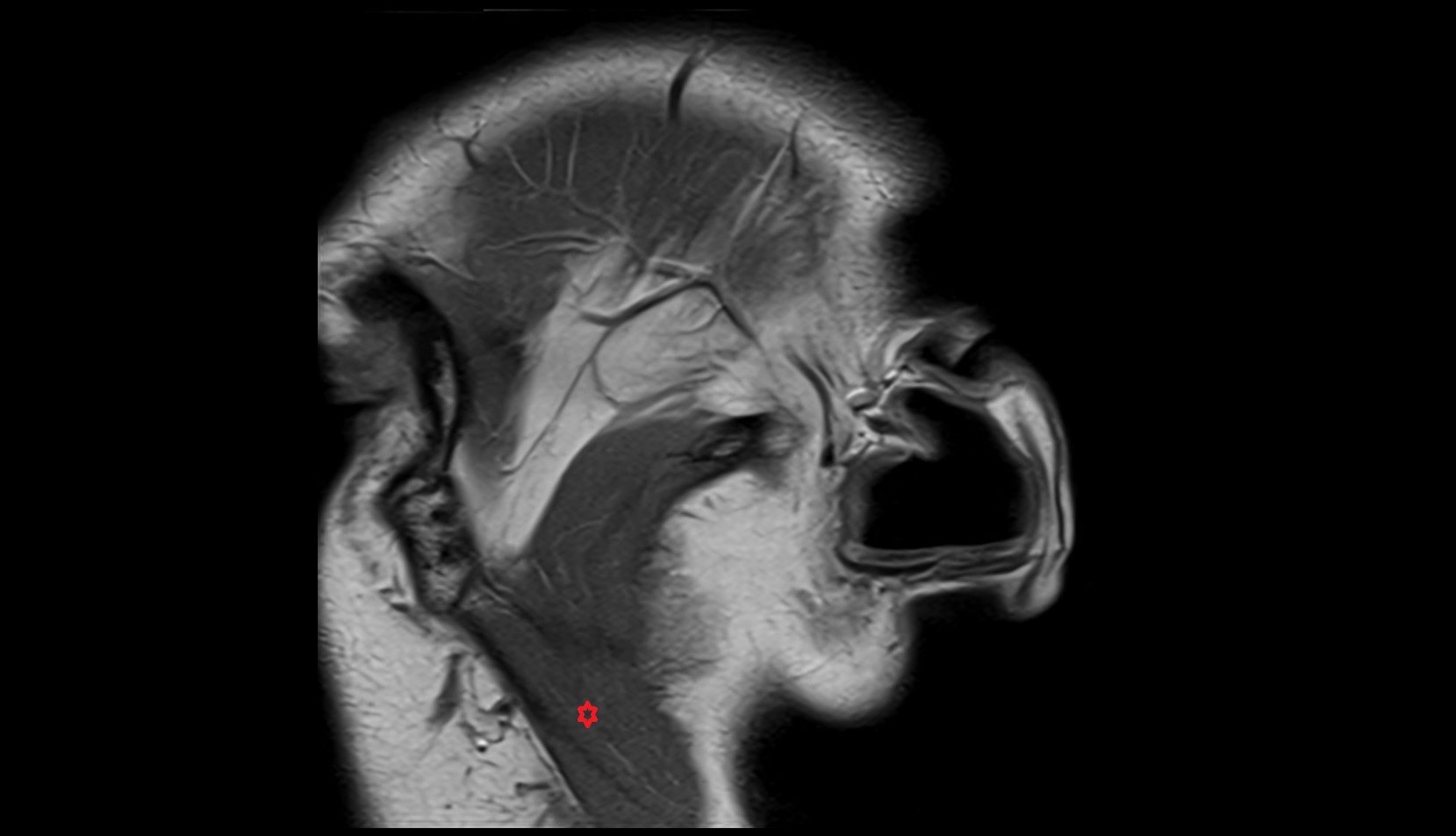 Superficial part of masseter muscle mri