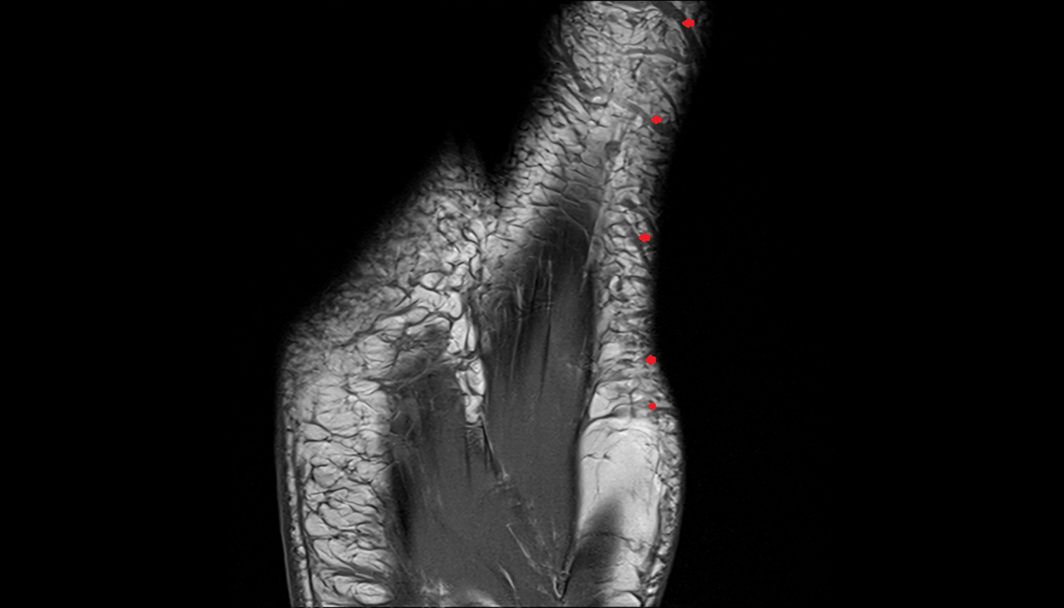 Superficial plantar venous plexus of foot  coronal cross sectional anatomy 3T MRI AI enhanced radiology image-img-00000-00000_00001