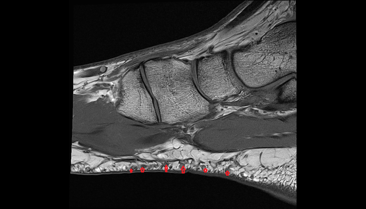 Superficial plantar venous plexus of foot  sag cross sectional anatomy 3T MRI AI enhanced radiology image-img-00000-00000