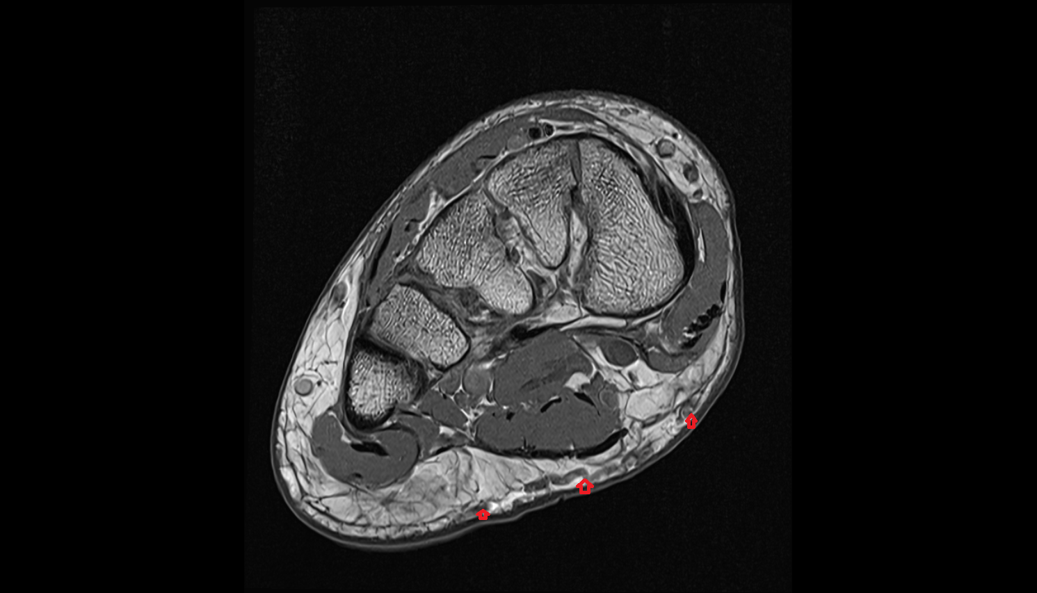 Superficial plantar venous plexus of foot  sag cross sectional anatomy 3T MRI AI enhanced radiology image-img-00000-00000_00001
