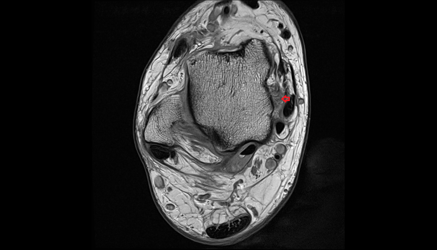 Superficial posterior tibiotalar ligament (Superficial deltoid) axial cross sectional anatomy 3T MRI AI enhanced radiology image-img-00000-00000
