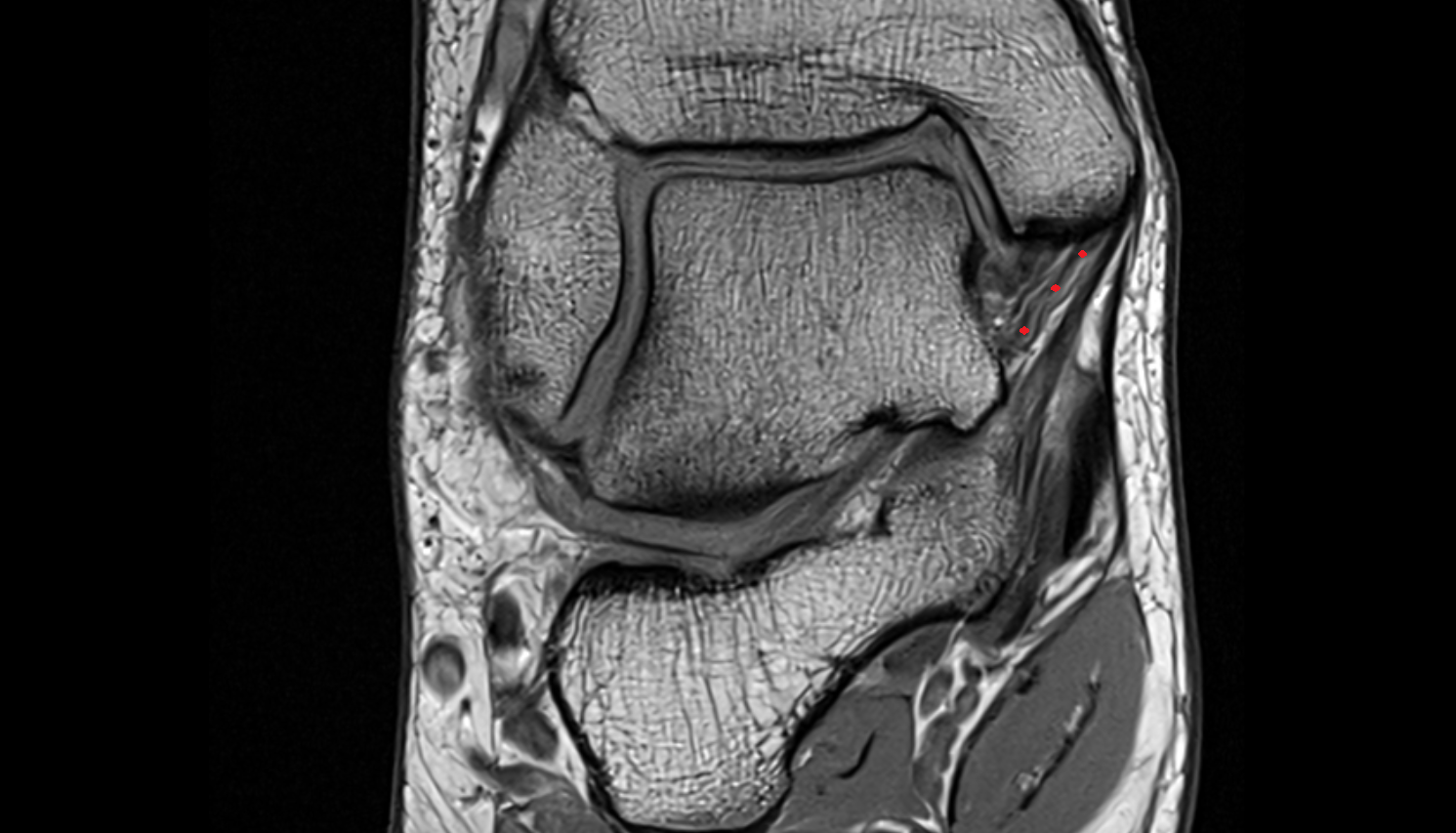 Superficial posterior tibiotalar ligament (Superficial deltoid) coronal cross sectional anatomy 3T MRI AI enhanced radiology image-img-00000-00000