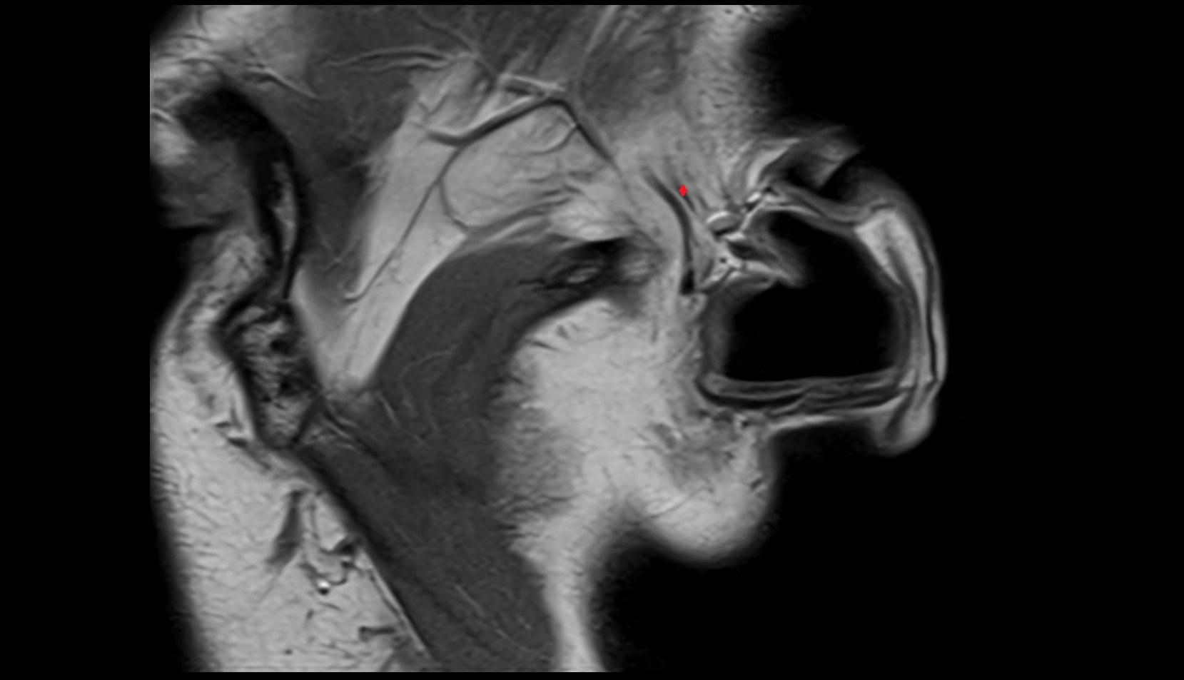 Superficial temporal artery mri image