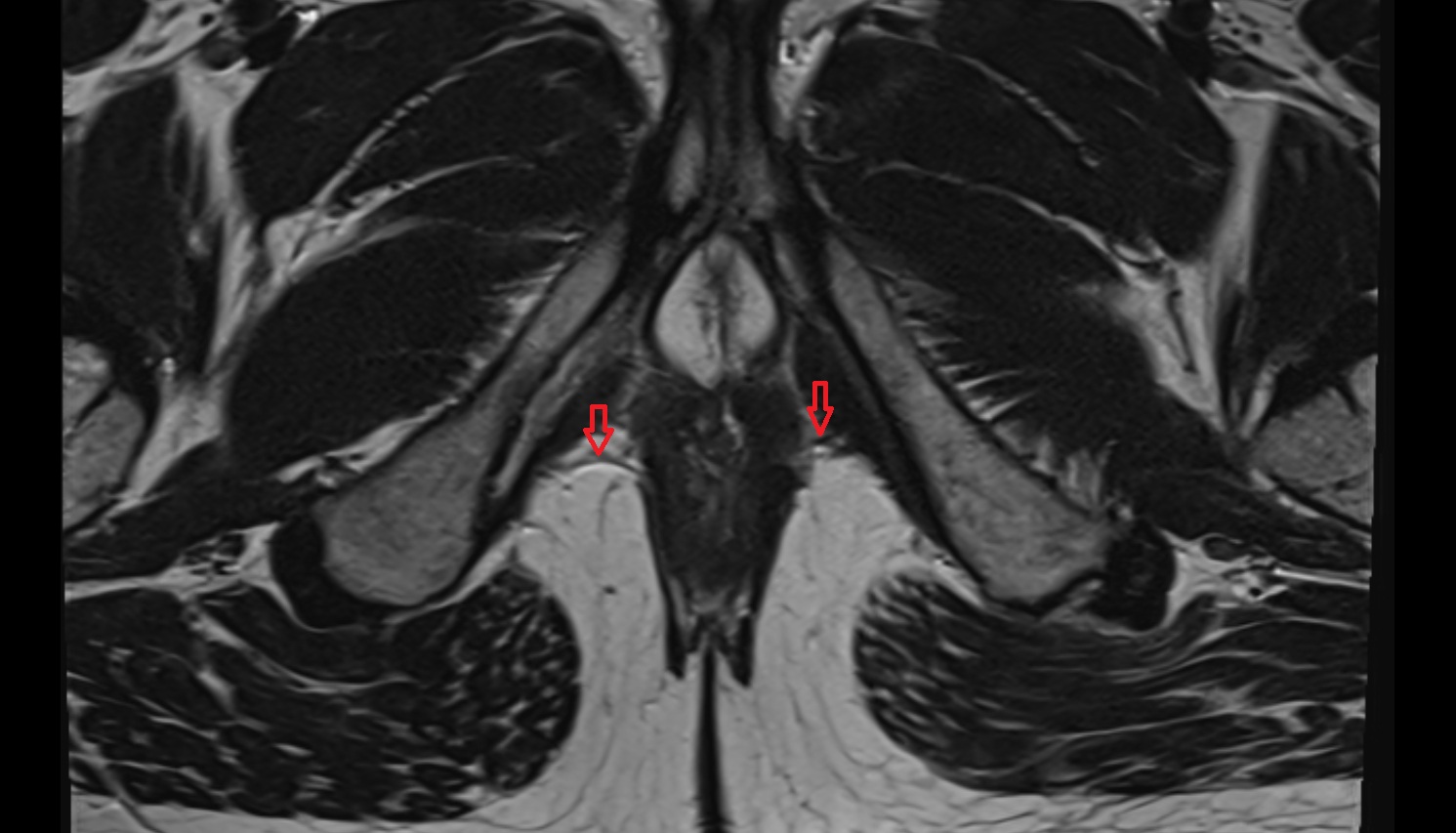 Superficial  transverse perineal muscle   MRI  axial  anatomy  image-img-00000-00000