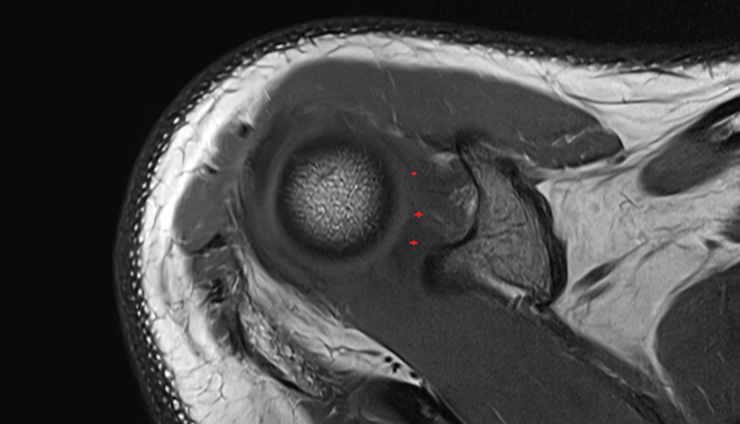 Superior Glenohumeral Ligament AXIAL cross sectional anatomy 3T MRI AI enhanced radiology image-img-00000-00000