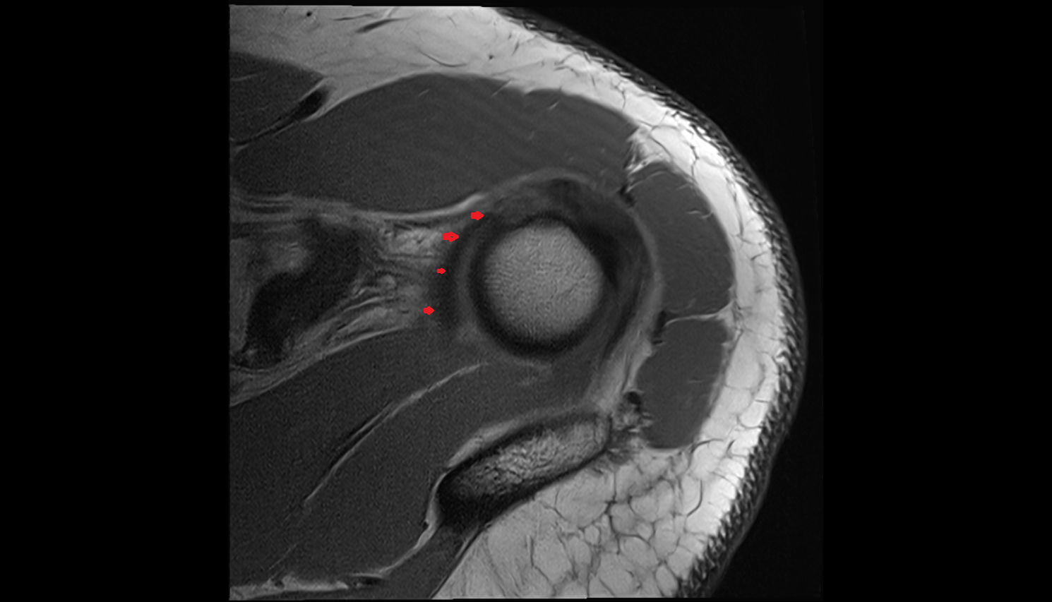Superior Glenohumeral Ligament (SGHL)  axial cross sectional anatomy 3T MRI AI enhanced radiology image-img-00000-00000