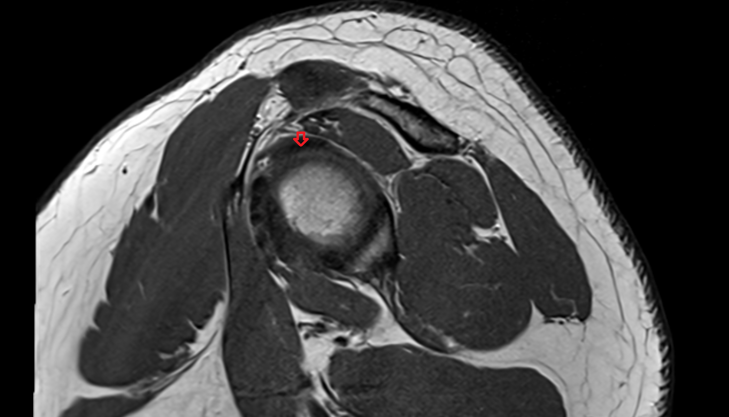 Superior Glenohumeral Ligament sagittal cross sectional anatomy 3T MRI AI enhanced radiology image-img-00000-00000