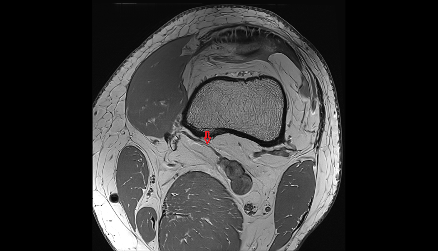 Superior Medial Genicular Vein axial cross sectional anatomy 3T MRI AI enhanced  radiology  anatomy image-img-00000-00000_00001