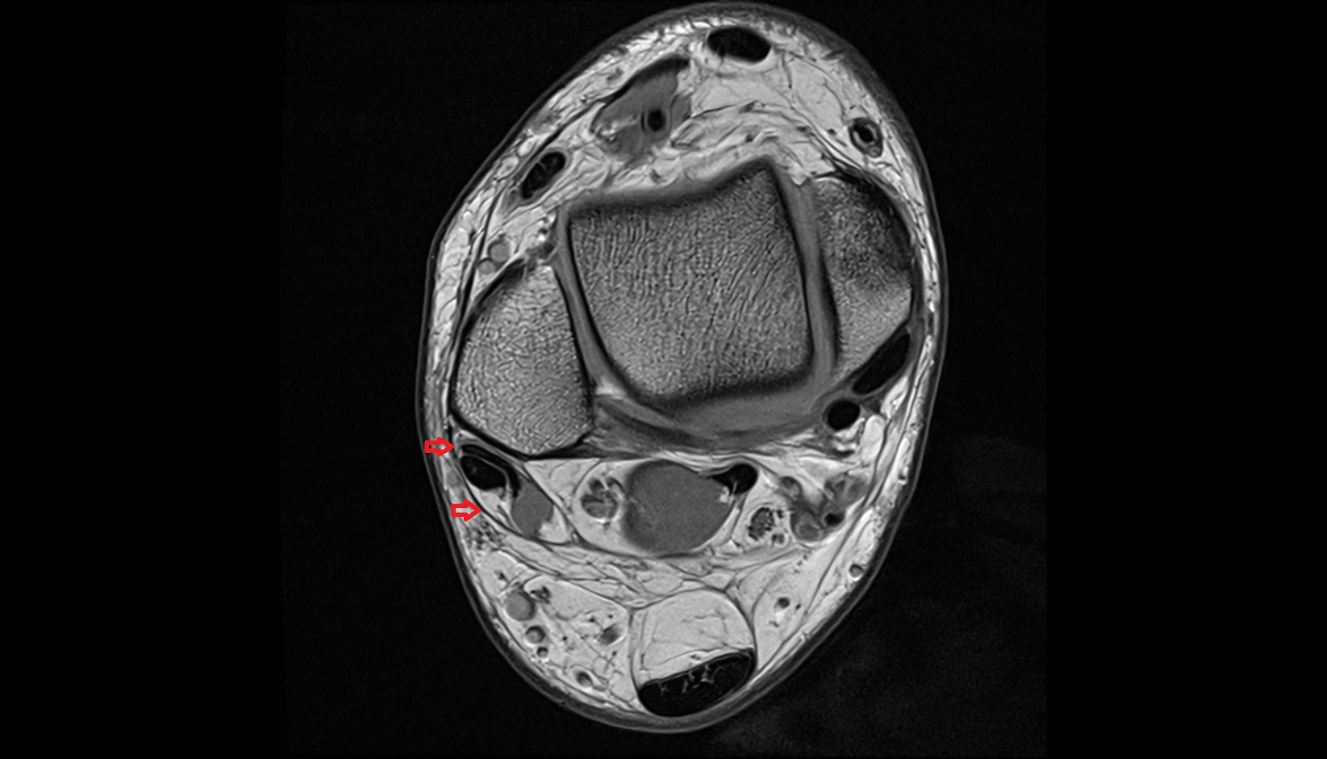 Superior peroneal (fibular) retinaculum axial  cross sectional anatomy 3T MRI AI enhanced radiology image-img-00000-00000
