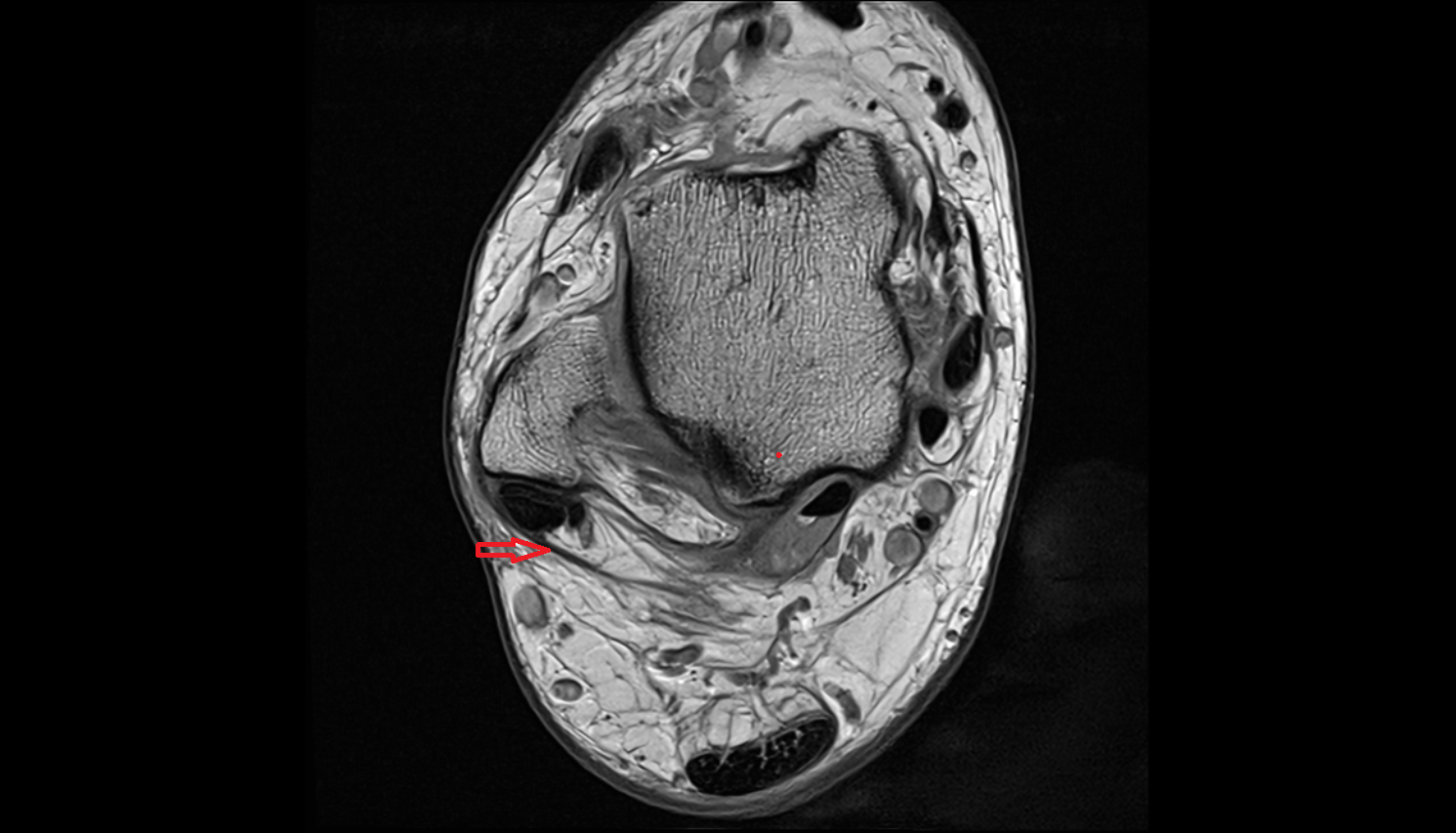 Superior Peroneal Retinaculum axial  cross sectional anatomy 3T MRI AI enhanced radiology image-img-00000-00000_00001