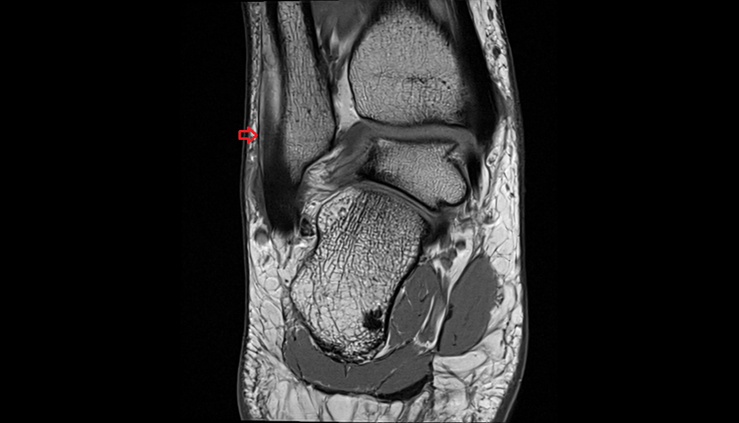 Superior peroneal (fibular) retinaculum coronal cross sectional anatomy 3T MRI AI enhanced radiology image-img-00000-00000