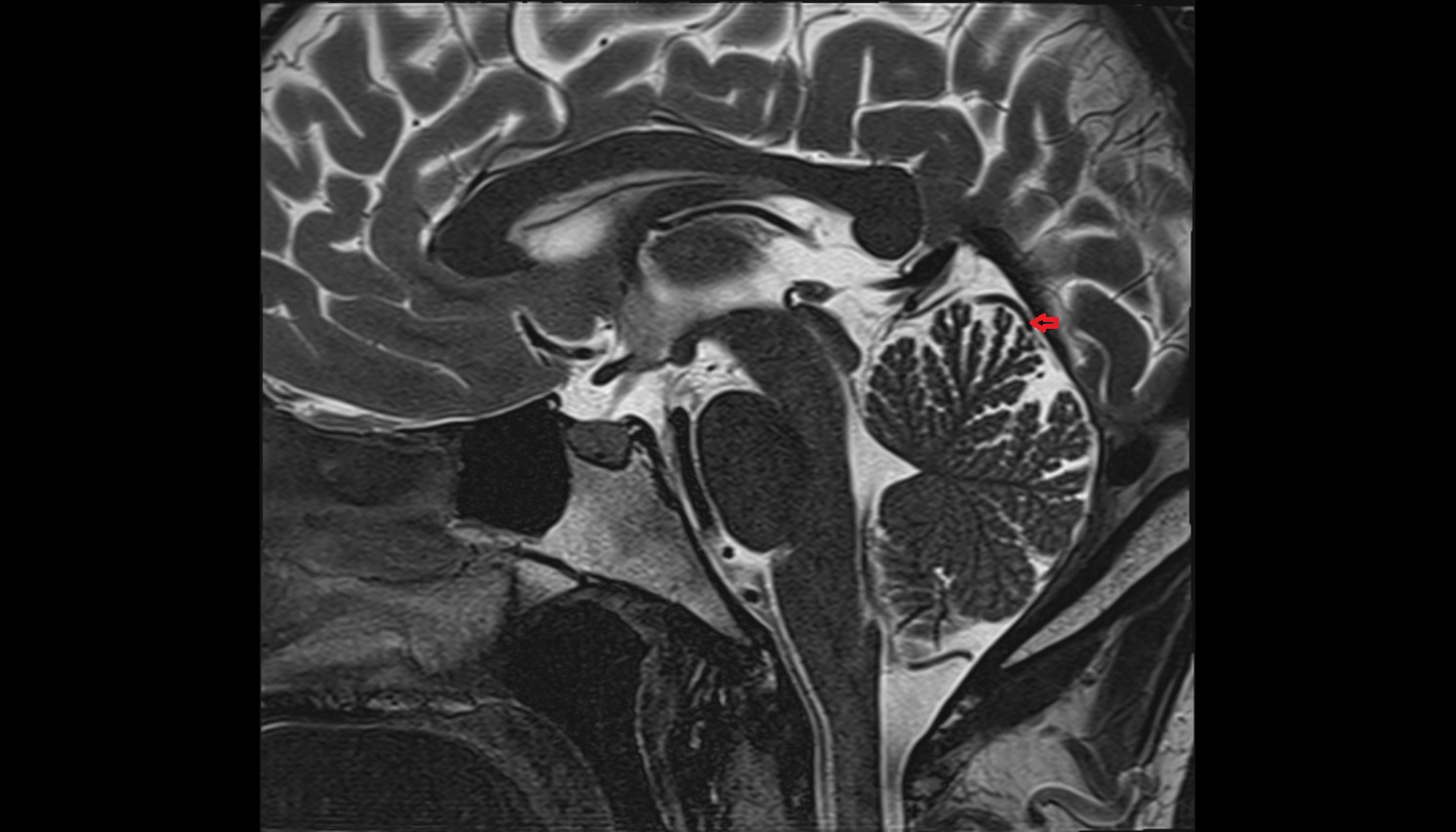 Superior Vermian Vein mri sagittal  image -img-00000-00000