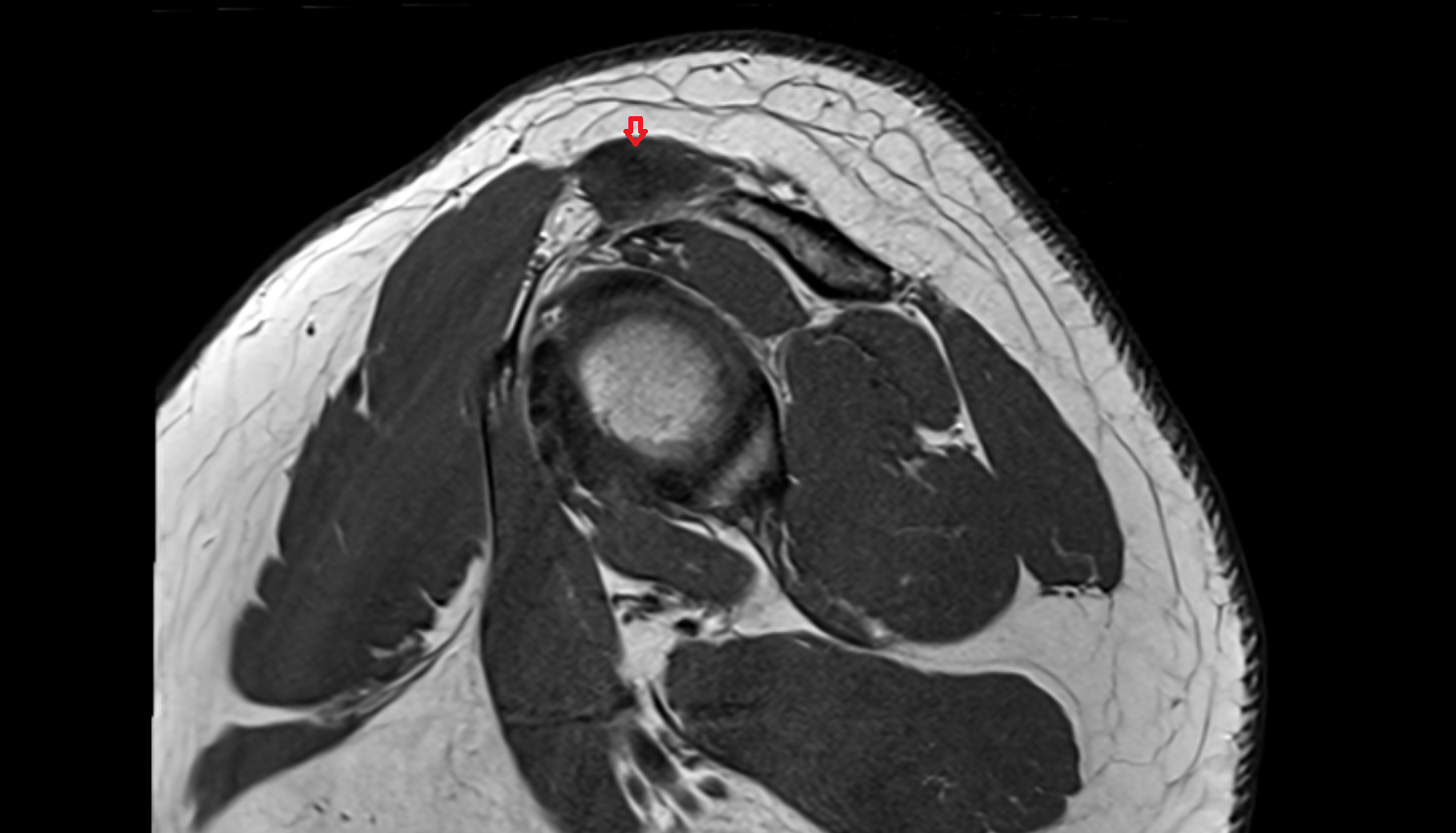 Superior acromioclavicular ligament  sag cross sectional anatomy 3T MRI AI enhanced radiology image-img-00000-00000