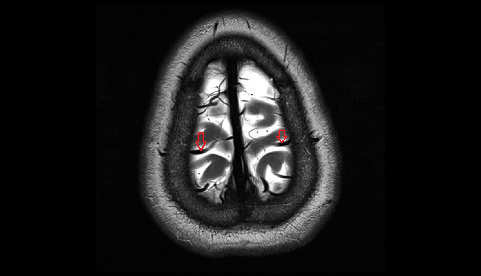 Superior anastomotic vein (Trolard) MRI 3T axial image