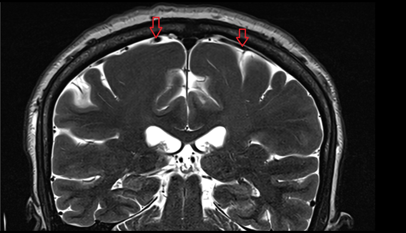 Superior anastomotic vein (Trolard) MRI 3T coronal image
