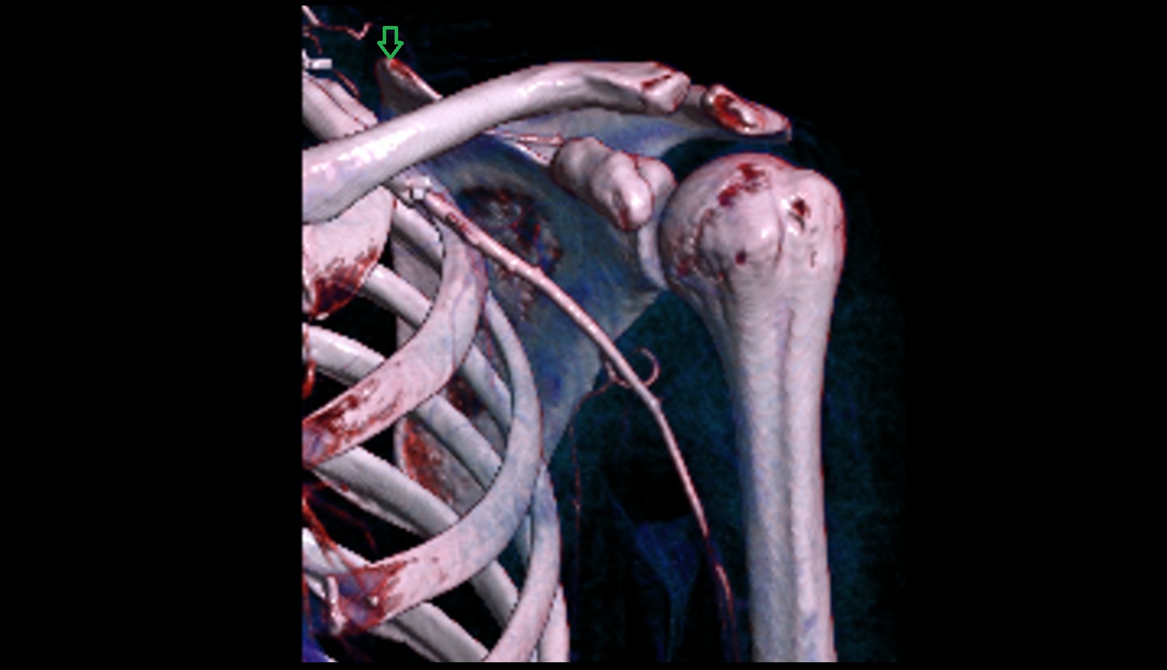 Superior angle of scapula