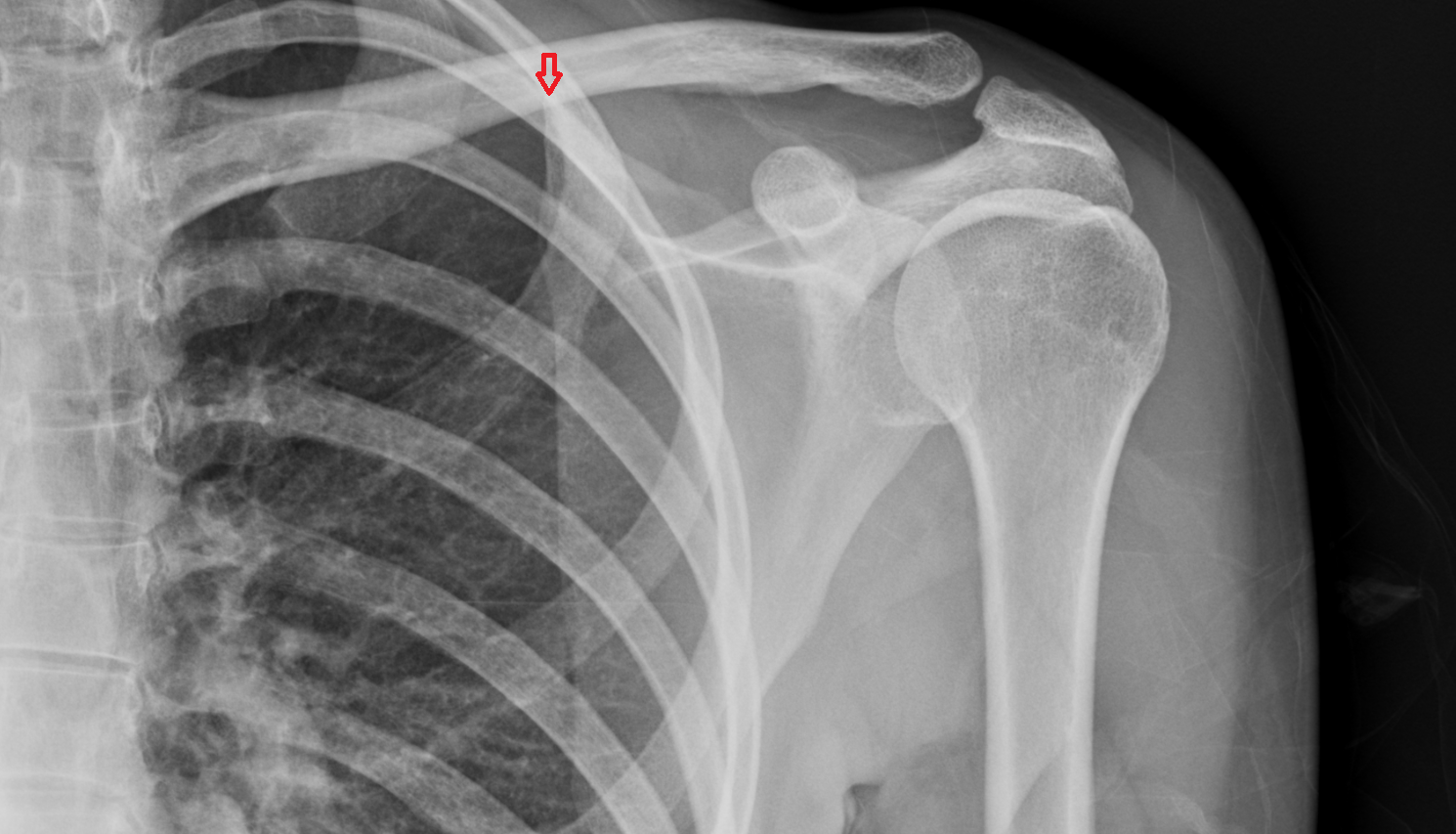 Superior angle of scapula x ray anatomy labelled image-img-00000-00000