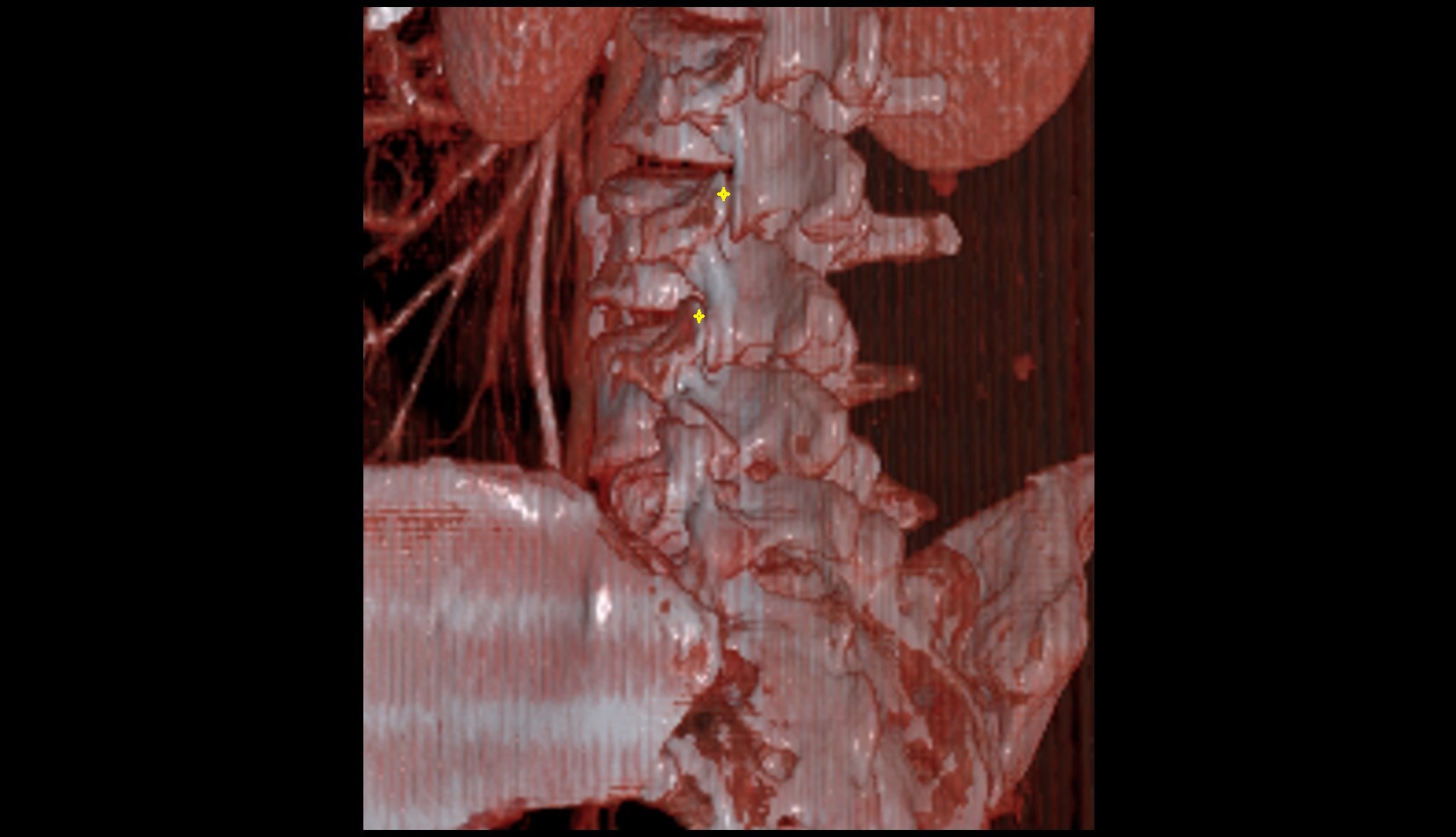 Superior articular processes of vertebrae ct  3D image