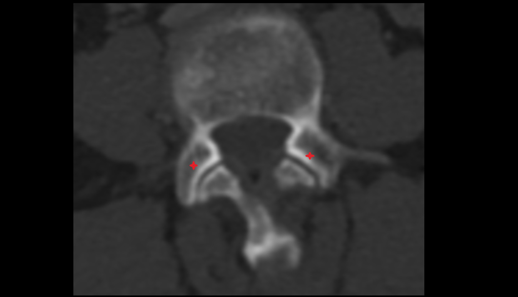Superior articular processes of vertebrae ct axial image