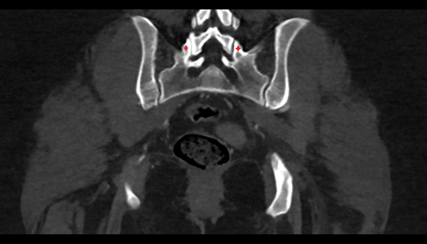 Superior articular process of S1 vertebra  ct coronal  anatomy  image-img-00000-00000