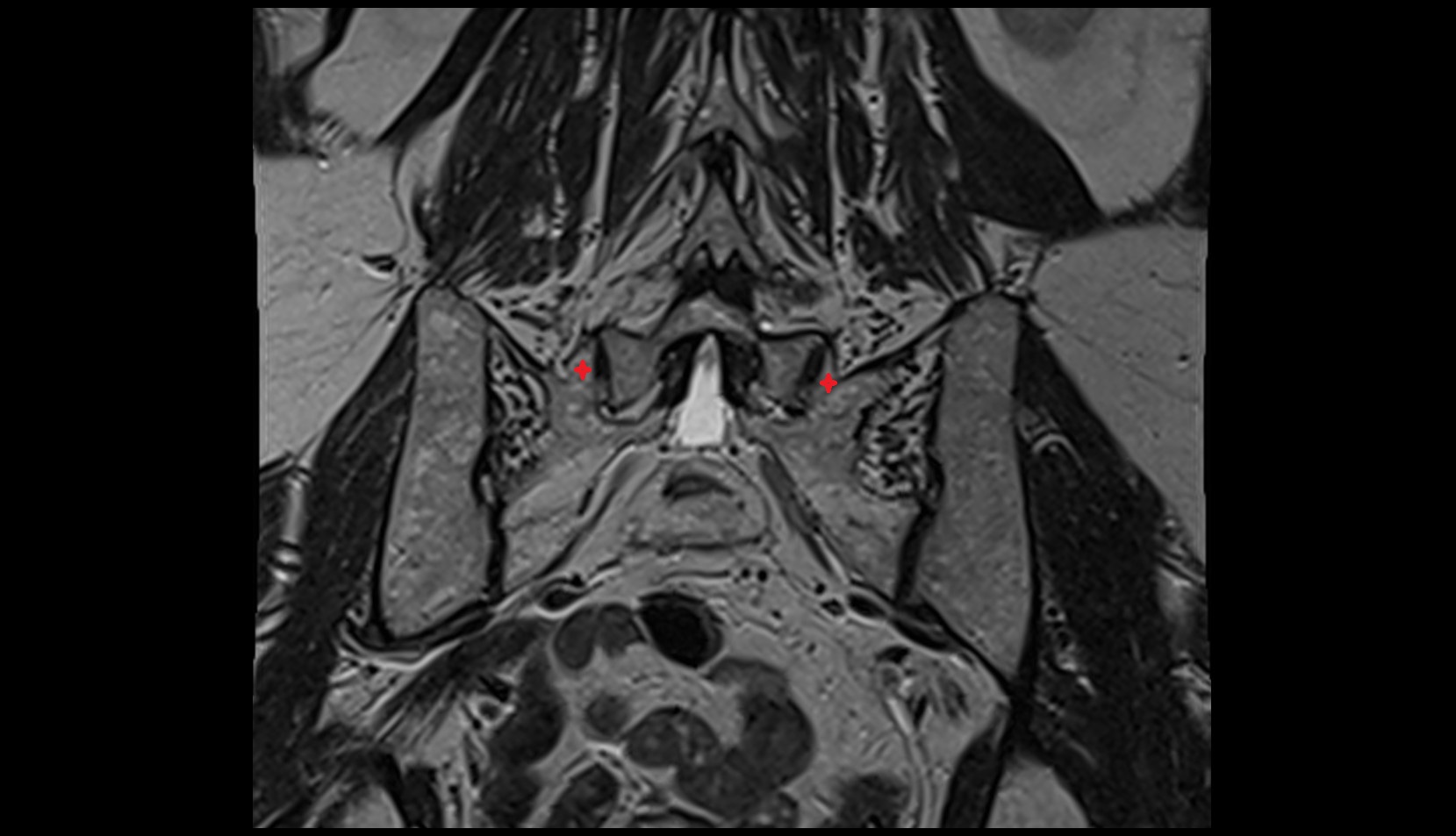 Superior articular process of S1 vertebra mri coronal image