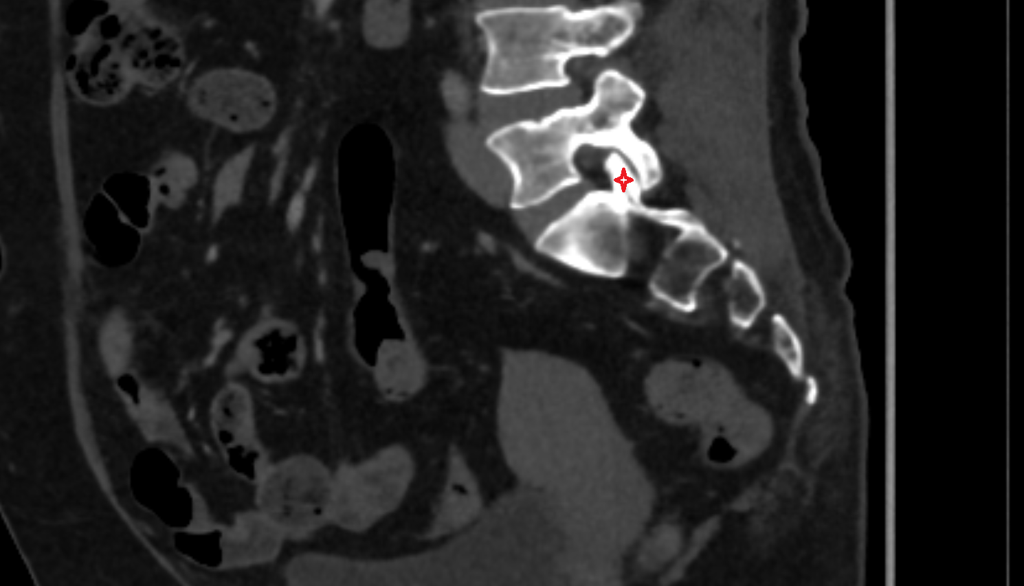 Superior articular process of sacrum CT  anatomy  Location and Imaging Appearance  -img-00000-00000