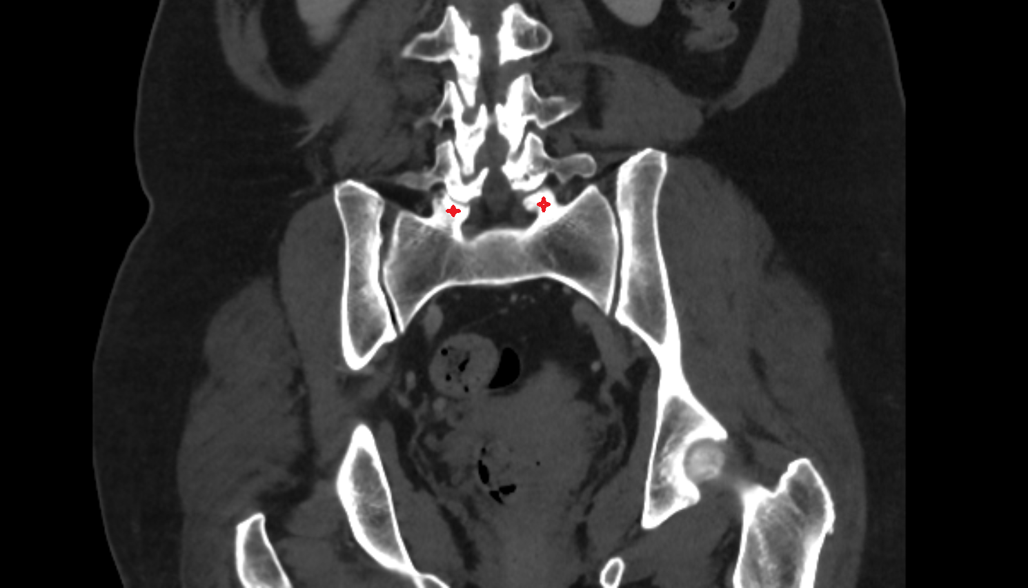 Superior articular process of sacrum CT  anatomy  Location and Imaging Appearance  -img-00000-00000_00001
