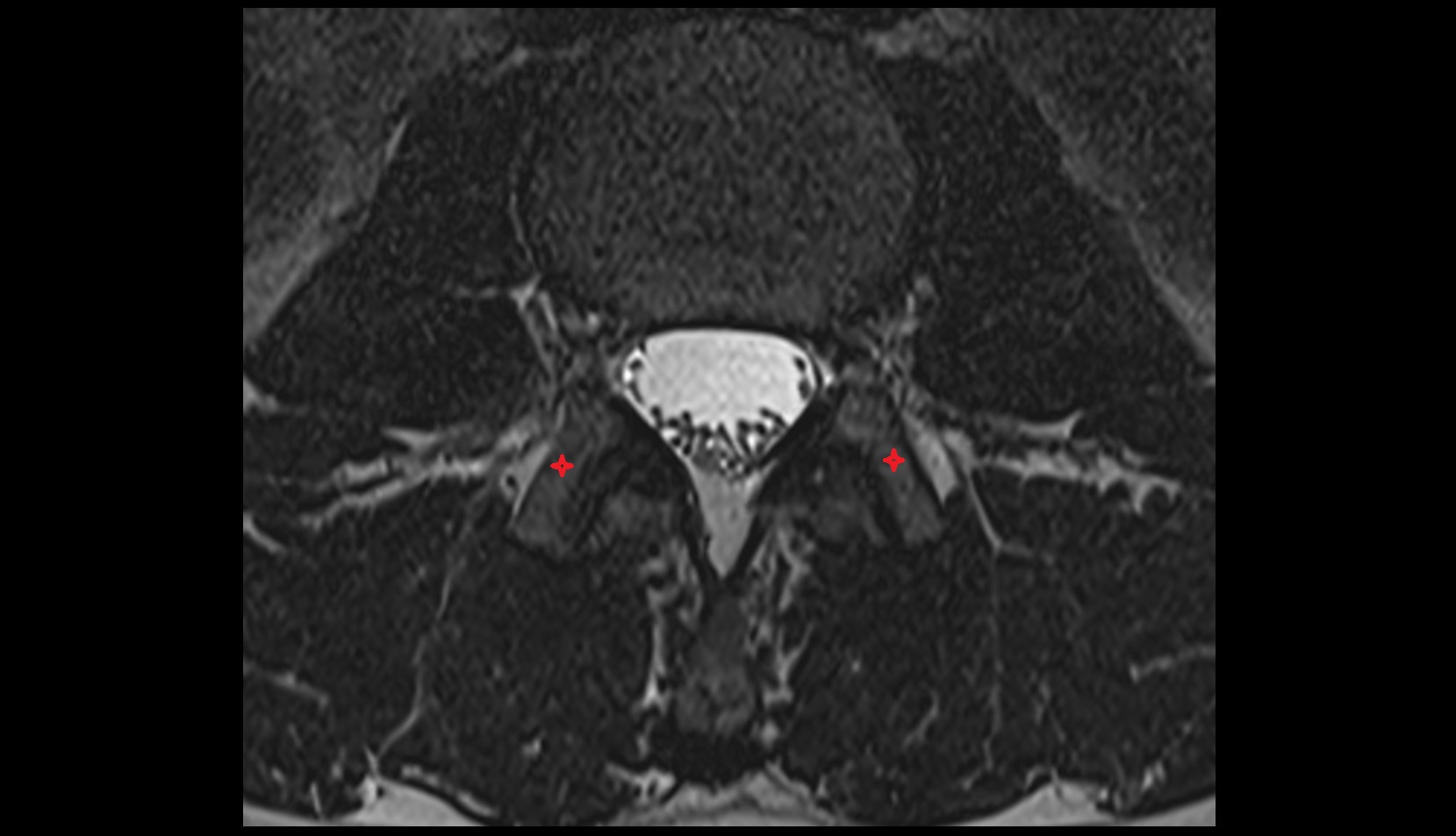 Superior articular process of vertebra mri axial image