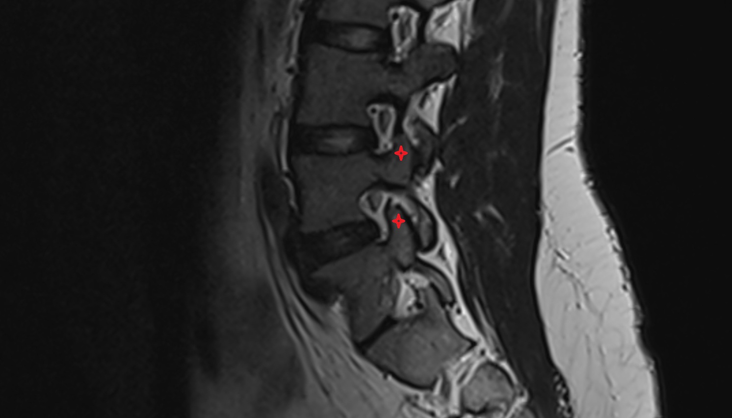 Superior articular process of vertebra  mri sag  image -img-00000-00000
