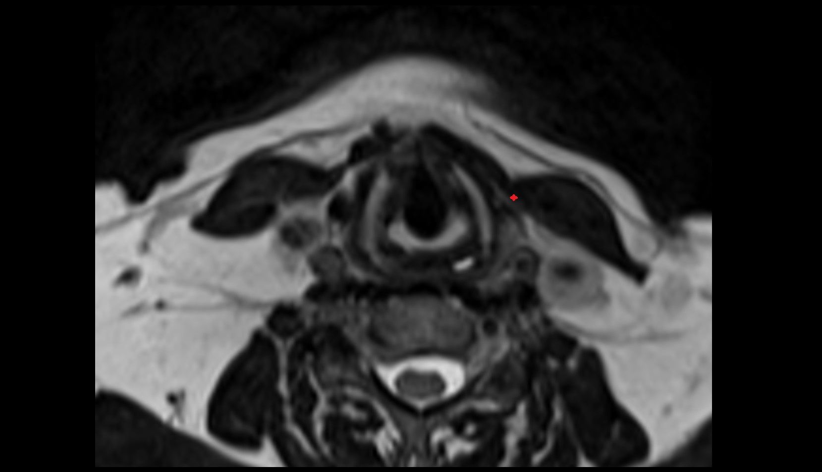 Superior belly of omohyoid muscle mri axial image