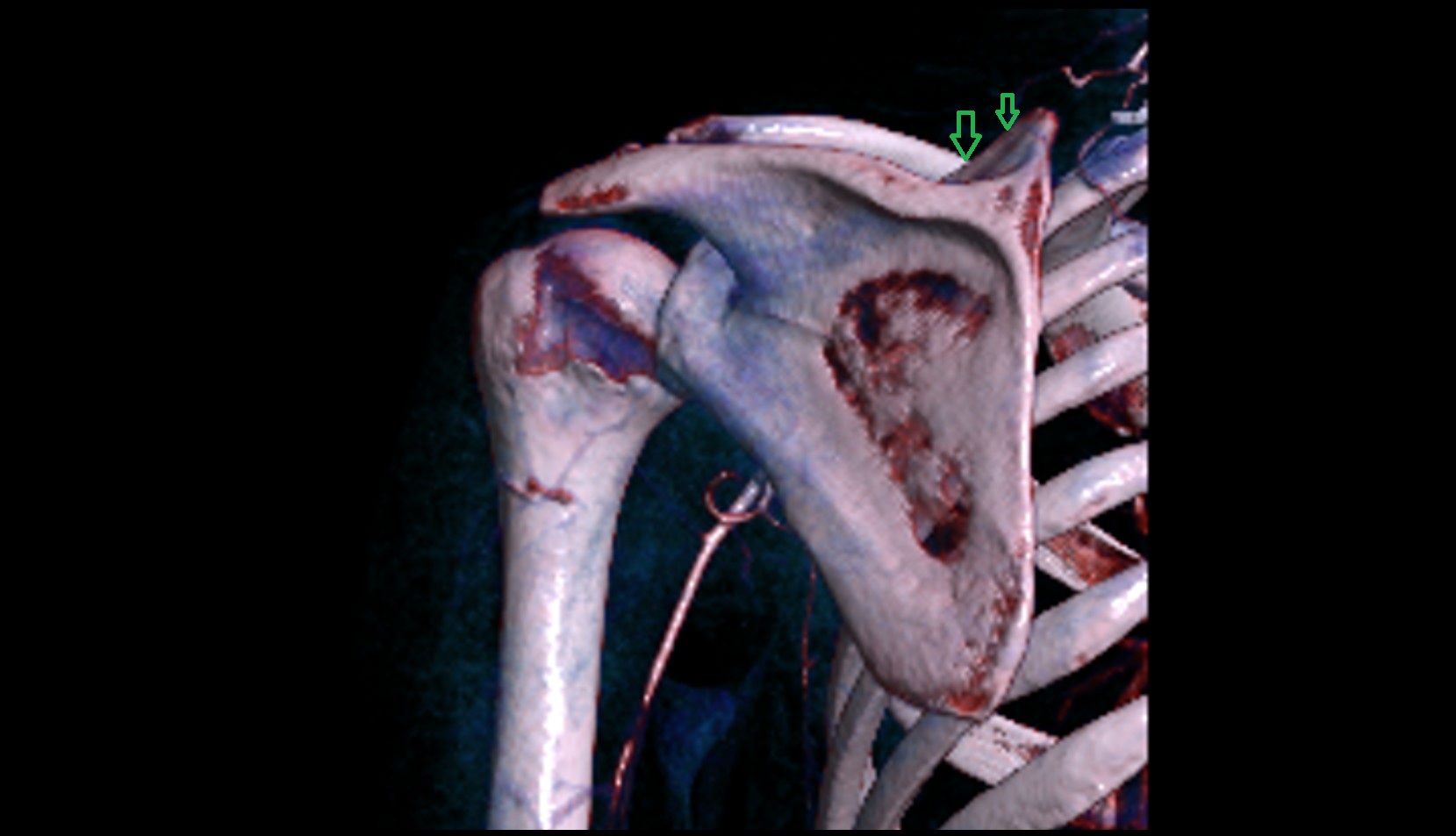 Superior border of scapula
