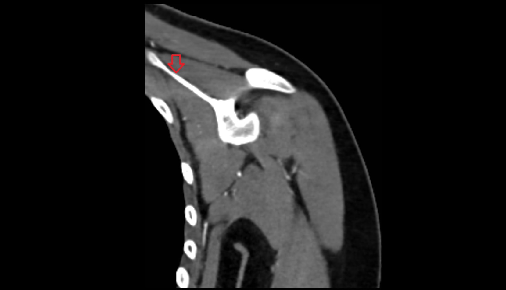 Superior border of scapula ct