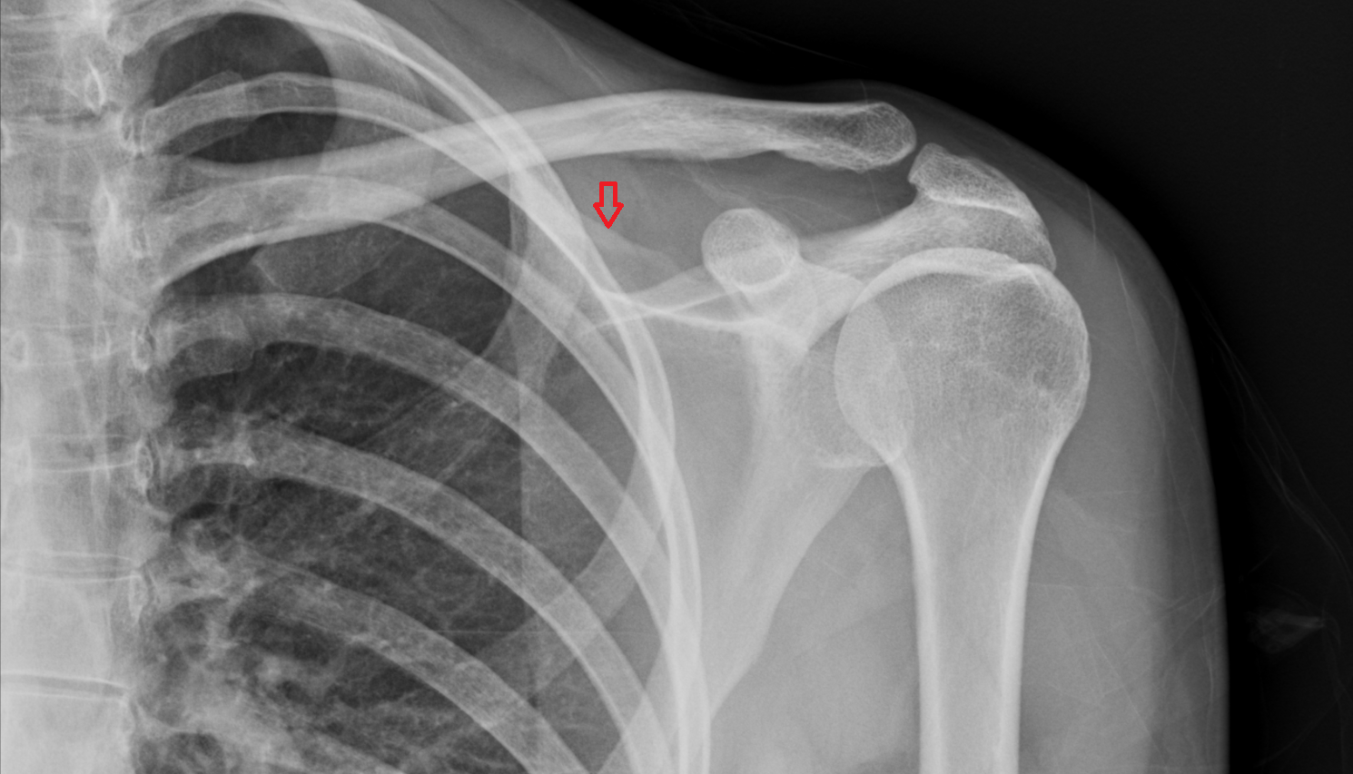 Superior border of scapula x ray anatomy labelled image-img-00000-00000