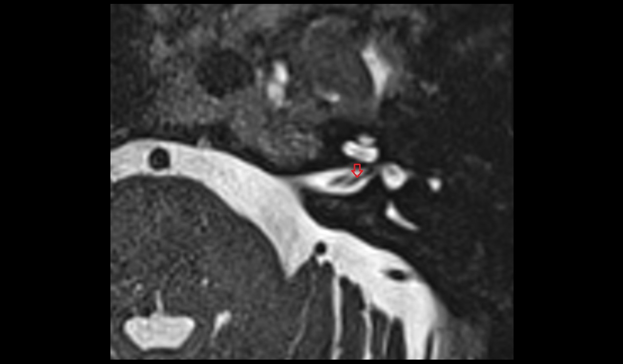 Superior branch of vestibular nerve MRI 3T image