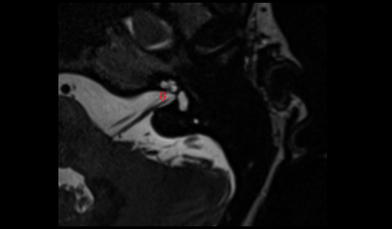 Superior branch of vestibular nerve MRI 3T image 1