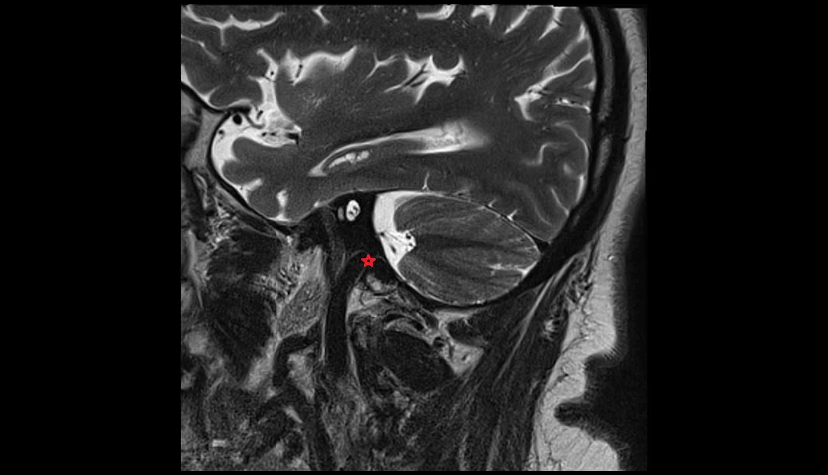 Superior bulb of internal jugular vein