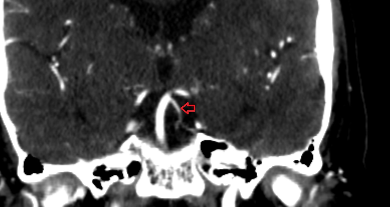 Superior cerebellar artery  CT coronal  anatomy image -img-00001-00001