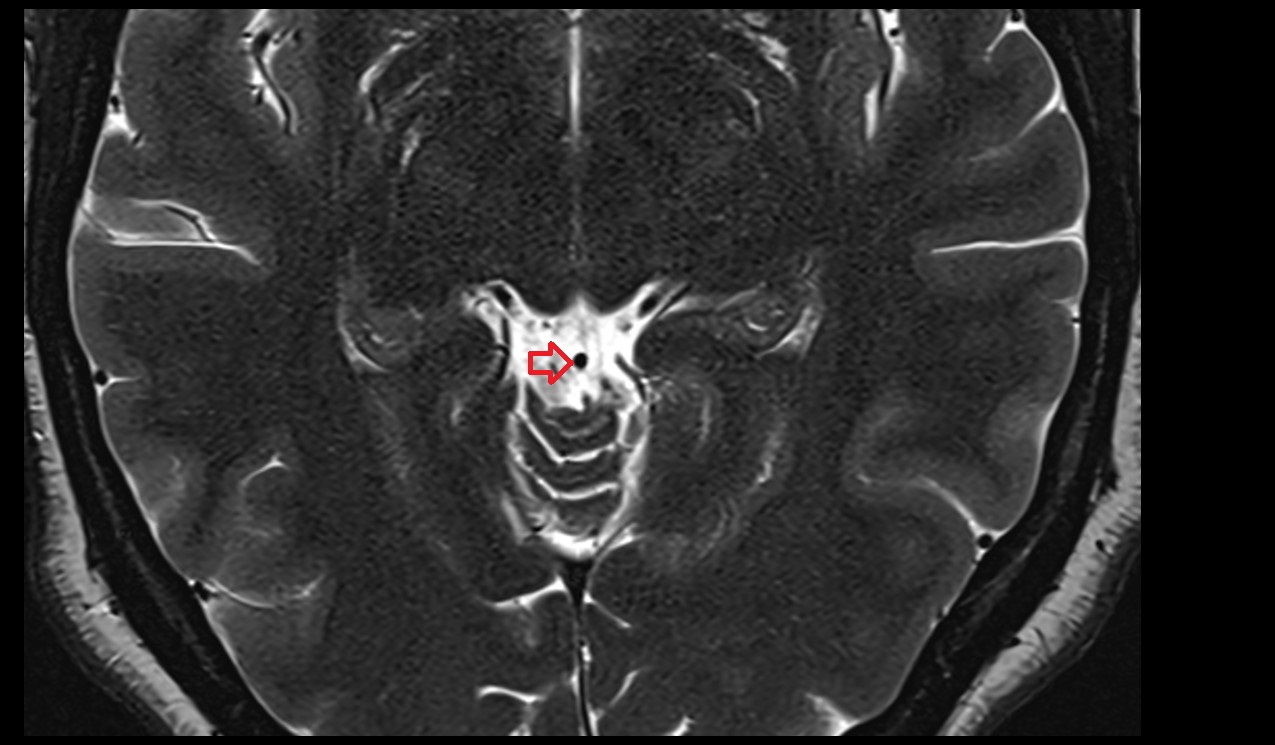 Superior cerebellar veins axial mri 3t image