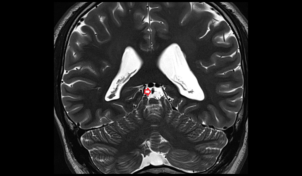 Superior cerebellar veins coronal mri 3t image