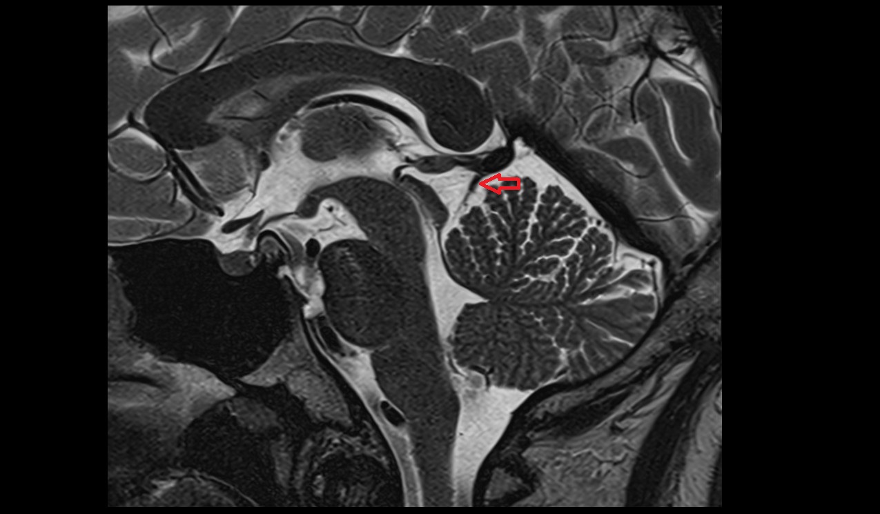Superior cerebellar veins sagittal mri 3t image