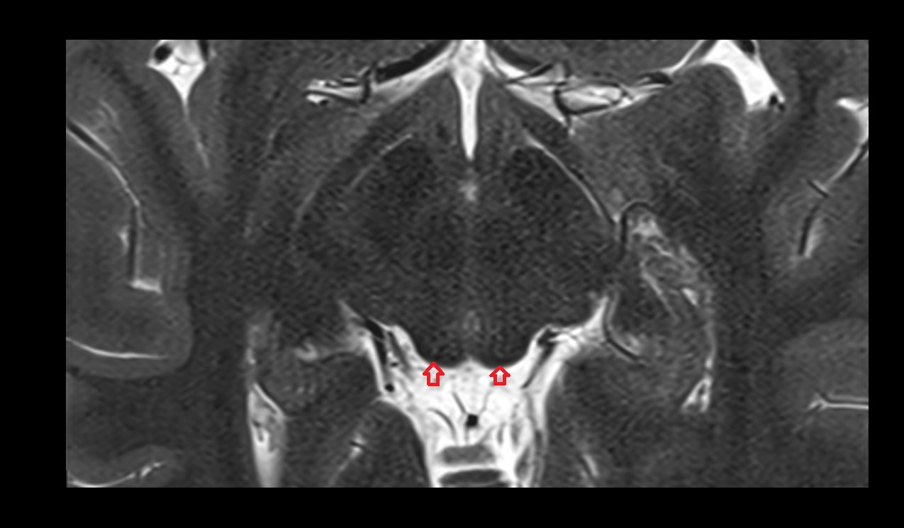 Superior colliculus mri 3t axial image