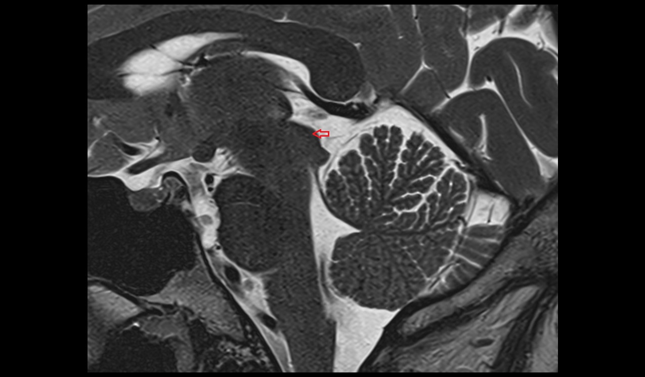 Superior colliculus mri 3t sagittal image