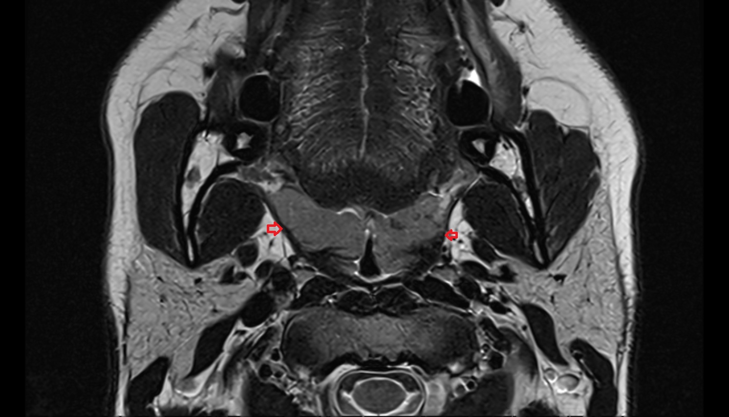 Superior constrictor muscle of pharynx mri axial image -img-00000-00000