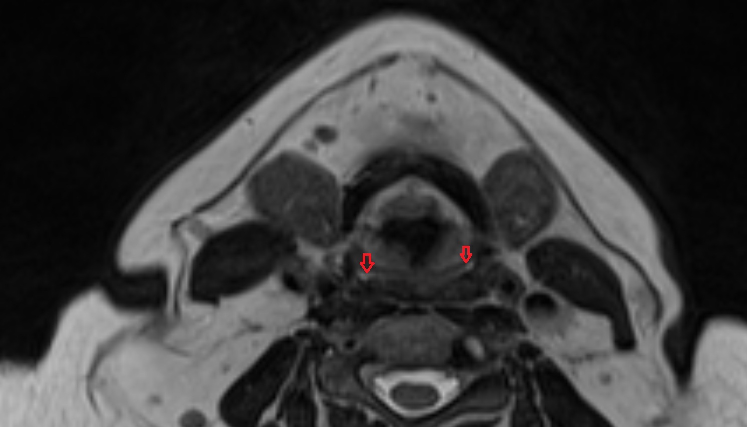 Superior cornu of thyroid cartilage  mri coronal image -img-00000-00000