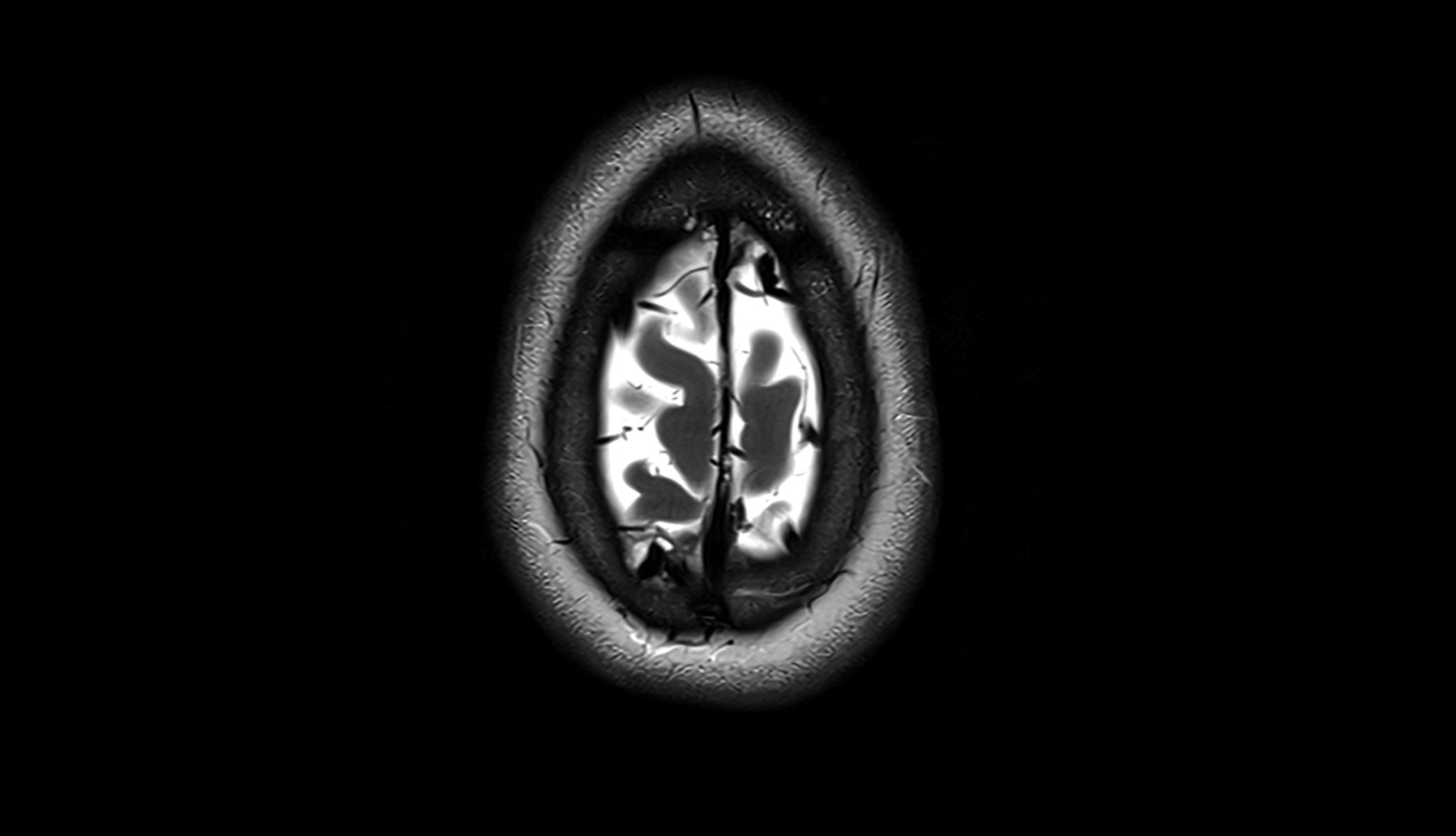 Superior cortical veins mri axial image